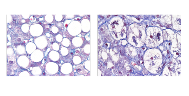 Maladie hépatique chronique : deux visages cachés de la MASH