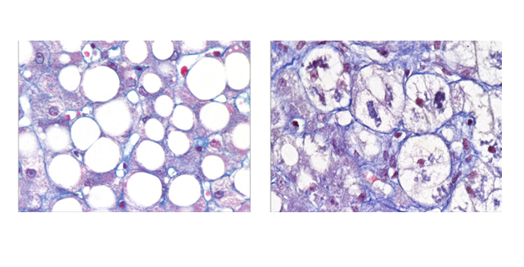 MASH : une double face de la maladie du foie