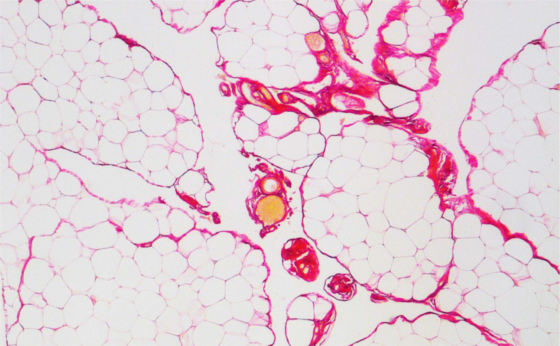 Obésité : des résultats prometteurs contre le développement de la fibrose