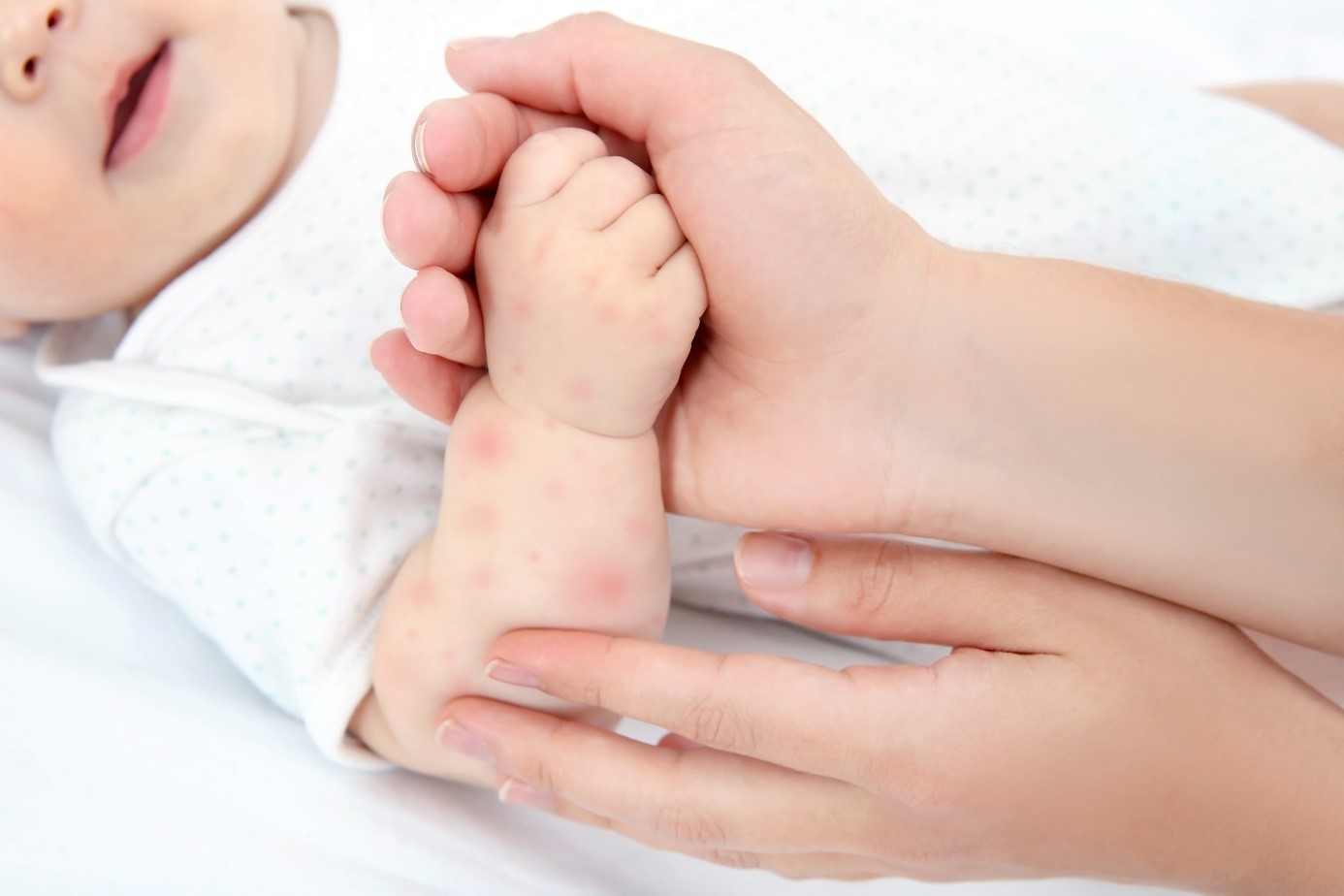 Eczéma du nourrisson : le stress pendant la grossesse pourrait être à l’origine de la maladie