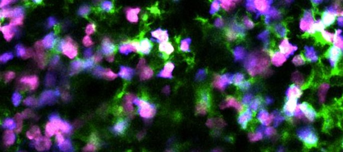 Cancer du sang : un traitement pour reprogrammer la mort de cellules cancéreuses et alerter le système immunitaire