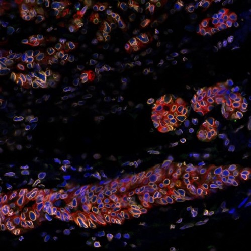 Rechutes du cancer du sein : découverte d’un mécanisme de résistance cellulaire clé