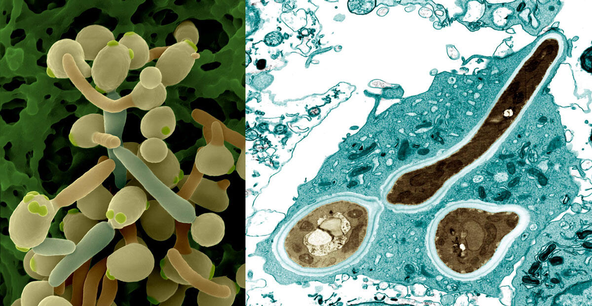 RÉVÉLATION CHOC : Le secret inavouable de la mycose enfin percé par des chercheurs français ! La fin d'un cauchemar ?