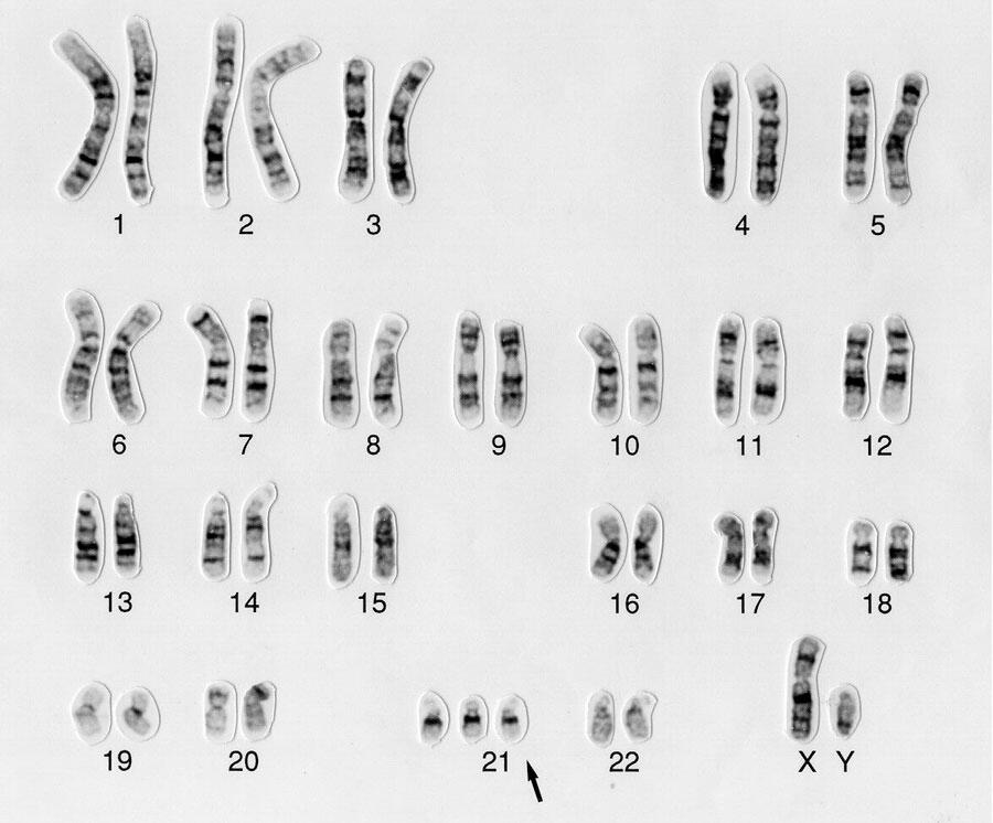 Marthe Gautier, découvreuse oubliée du chromosome de la trisomie 21