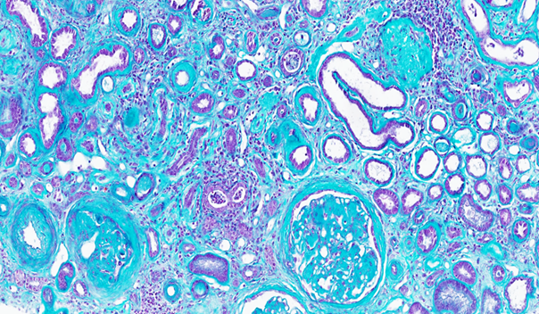 Découverte d’un nouveau mécanisme clé de la progression des maladies rénales